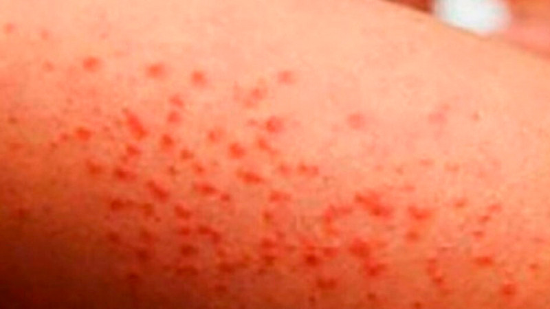 Confirman primer fallecimiento por sarampión en CDMX; brote deja 28 muertes a nivel nacional