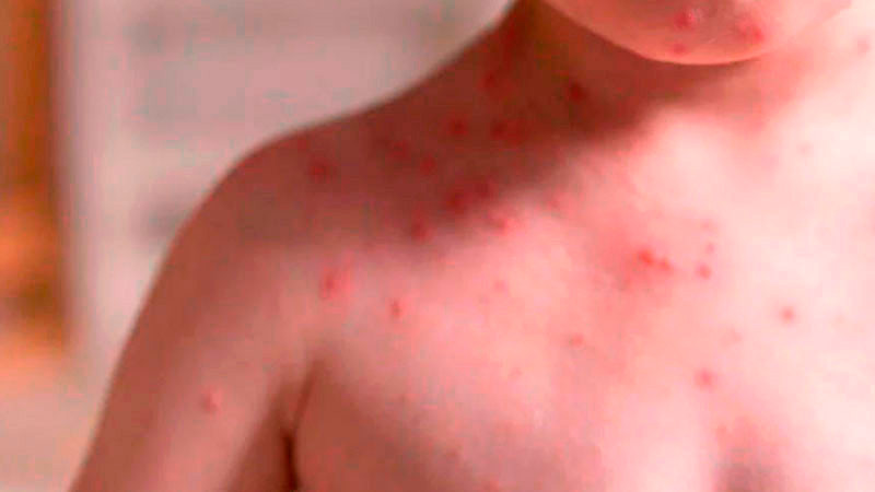 Hay más de 20 millones de dosis contra sarampión, anuncia Salud